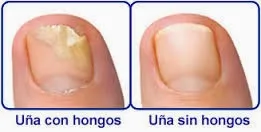 ELIMINAR LOS HONGOS