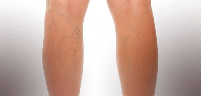 VARICES: EMOCIONES QUE NO FLUYEN