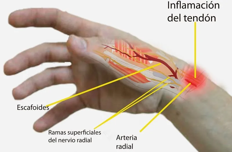 conflicto emocional tendinitis